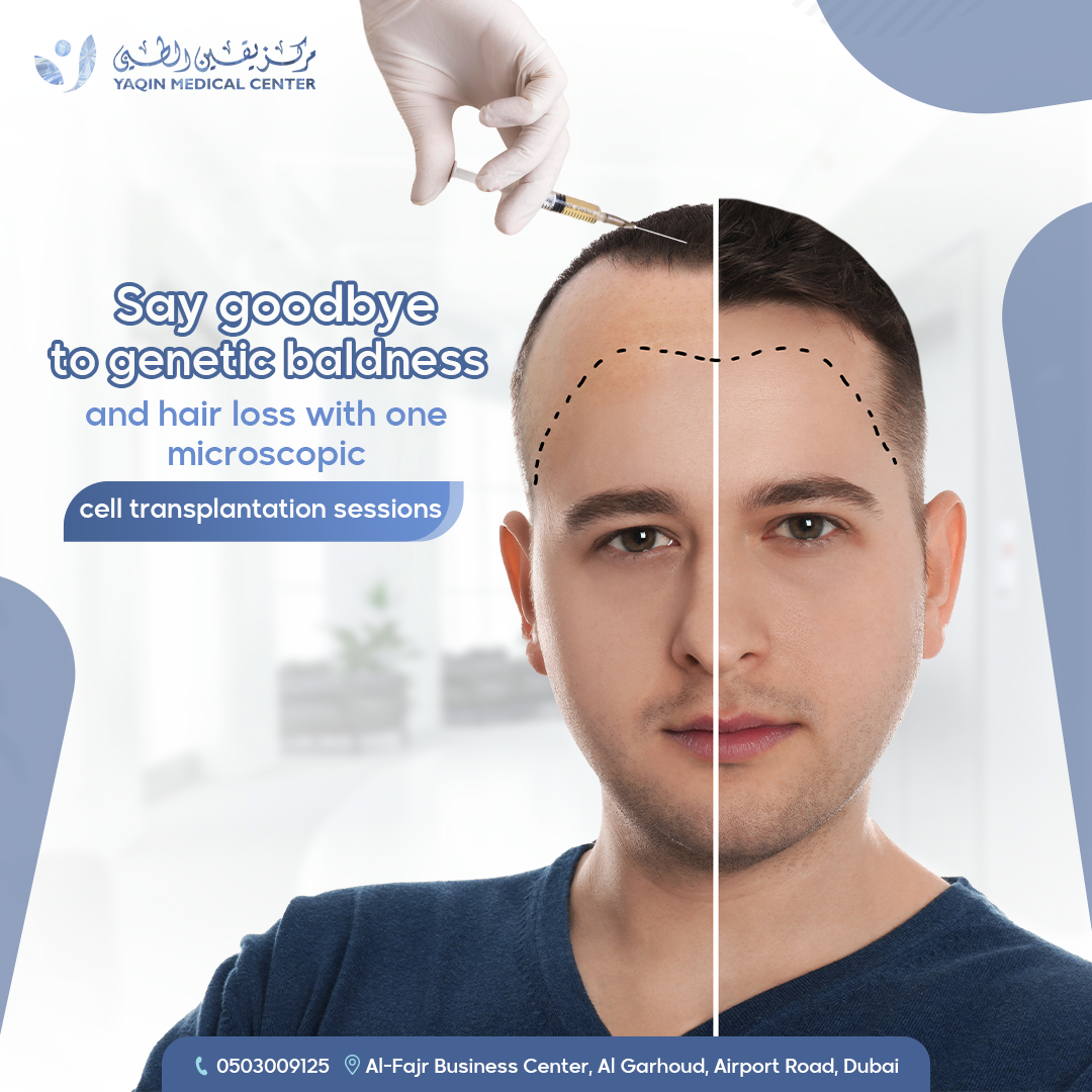 hereditary baldness - Copy